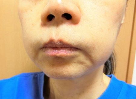 口コミ：シュワトレーゼ　薬用リンクルホワイトゲル　洗顔後はこれ一つ。あらゆる肌悩みをオールケア！の画像（13枚目）
