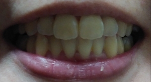 口コミ：歯の美白の画像（1枚目）