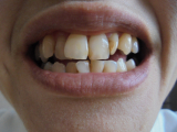 口コミ記事「ツルツルになった歯」の画像