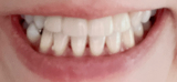 口コミ：歯の黄ばみ撃退にオススメの薬用ホワイトニング　デンタブラッシュEXの画像（1枚目）