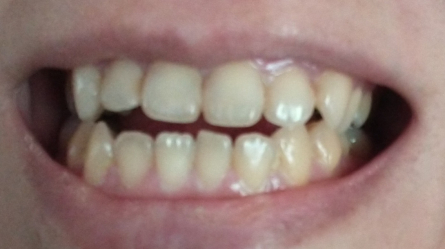 口コミ：歯の美白美容液 感想の画像（3枚目）