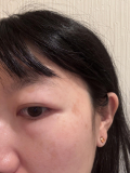 「一度焼いたシミが復活しました」の画像（2枚目）