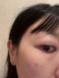 「一度焼いたシミが復活しました」の画像（1枚目）