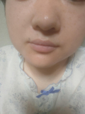 ほうれい線が気になります