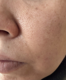 「頬の毛穴」の画像（1枚目）