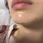 「最近荒れてきたニキビ」シミキールナイトバームの”発売前先行モニター”募集♡の投稿画像