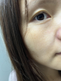 ほほに小さなシミがポツポツ出来ている