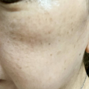 「頬に無数のシミ(；´Д`A」シミキールナイトバームの”発売前先行モニター”募集♡の投稿画像