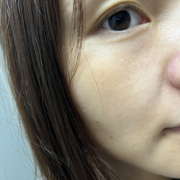 「ほほに小さなシミがポツポツ出来ている」シミキールナイトバームの”発売前先行モニター”募集♡の投稿画像