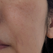 「頬のシミの様子」シミキールナイトバームの”発売前先行モニター”募集♡の投稿画像