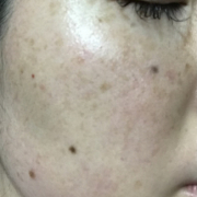 「頬のシミそばかすやニキビ跡」シミキールナイトバームの”発売前先行モニター”募集♡の投稿画像