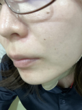 毛穴の開きが悩みです。