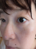 「頬の部分にそばかすがあるんです。」の画像（1枚目）