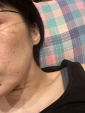 くすみ、しみ